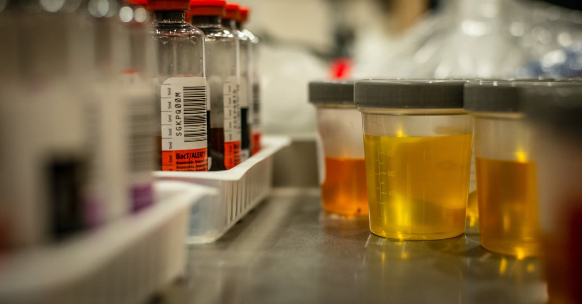 urine samples on a table for testing